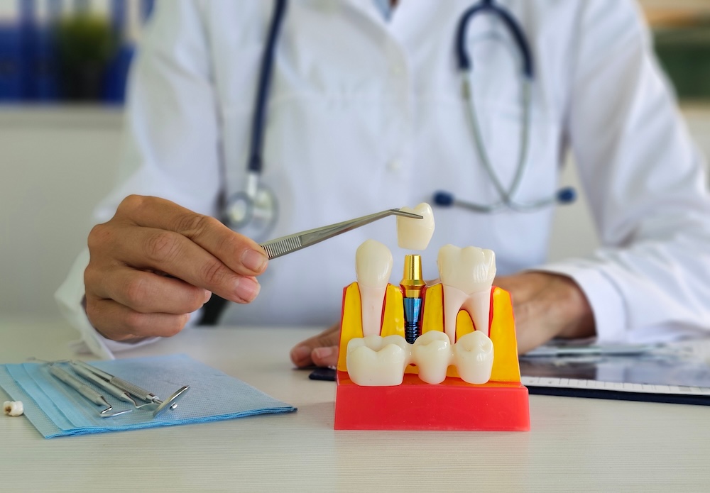 dentist showing teeth model - dental bonding puyallup dentist showing teeth model - dental bonding puyallup